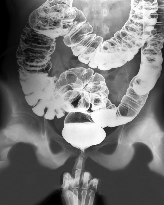 x-ray of a pelvis and intestines with a middle finger inserted into the rear